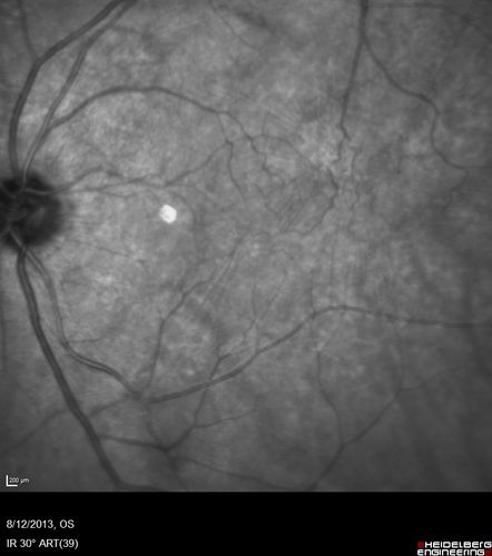 Macular Hole Left Eye - progression from VMT - Stage II macular hole - Spontaneously Closed Macular Hole
