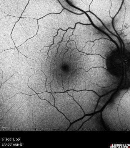 Vitreomacular Traction -> Macular Hole -> Aborted Macular hole
Progression of VMT in both eyes over time
