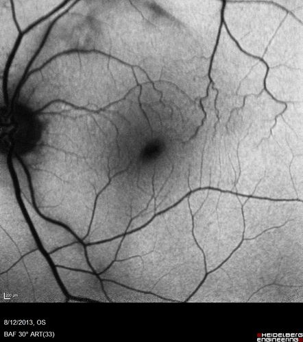 Macular Hole Left Eye - progression from VMT - Stage II macular hole - Spontaneously Closed Macular Hole
