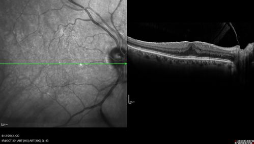Macular Hole Left Eye - progression from VMT - Stage II macular hole - Spontaneously Closed Macular Hole
