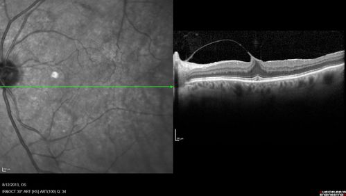 Macular Hole Left Eye - progression from VMT - Stage II macular hole - Spontaneously Closed Macular Hole
Asymptomatic VMT OS with 20/30 VA
