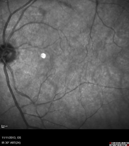 Macular Hole Left Eye - progression from VMT - Stage II macular hole - Spontaneously Closed Macular Hole
