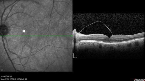 Macular Hole Left Eye - progression from VMT - Stage II macular hole - Spontaneously Closed Macular Hole
Vision better left eye VMT has released the fovea (was 20/25)
