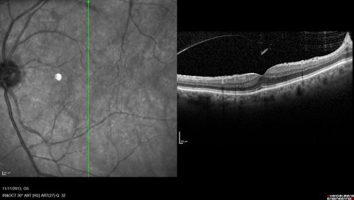Vitreomacular Traction -> Macular Hole -> Aborted Macular hole
Progression of VMT in both eyes over time
