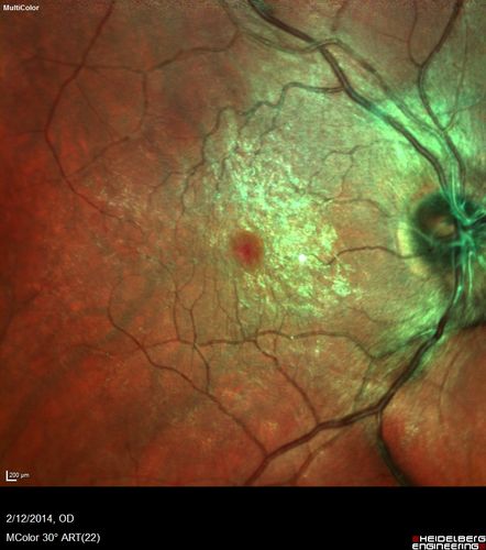 Macular Hole Left Eye - progression from VMT - Stage II macular hole - Spontaneously Closed Macular Hole
Pucker False Color
