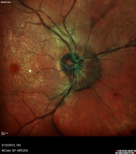 Macular Hole Left Eye - progression from VMT - Stage II macular hole - Spontaneously Closed Macular Hole

