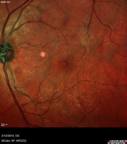 Macular Hole Left Eye - progression from VMT - Stage II macular hole - Spontaneously Closed Macular Hole
Vision has dropped to 20/50 and there is a full thickness macular hole
