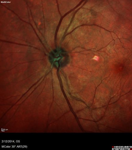 Vitreomacular Traction -> Macular Hole -> Aborted Macular hole
Progression of VMT in both eyes over time
