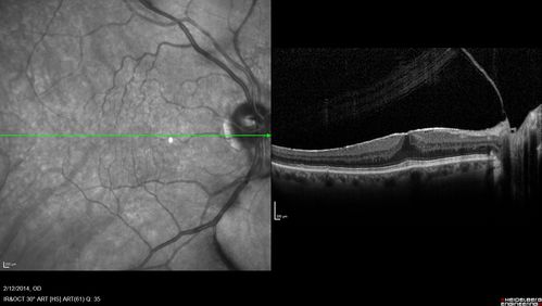 Vitreomacular Traction -> Macular Hole -> Aborted Macular hole
Progression of VMT in both eyes over time
