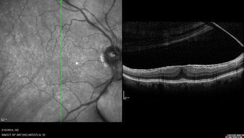 Macular Hole Left Eye - progression from VMT - Stage II macular hole - Spontaneously Closed Macular Hole
Pucker in fellow eye is stable

