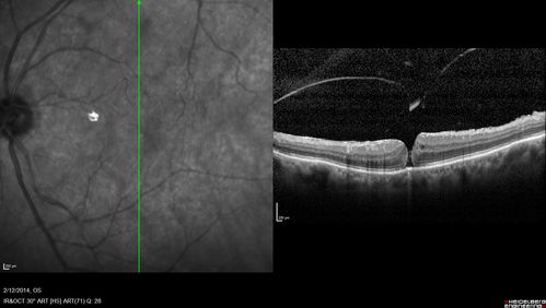 Macular Hole Left Eye - progression from VMT - Stage II macular hole - Spontaneously Closed Macular Hole
Vision has dropped to 20/50 and there is a full thickness macular hole
