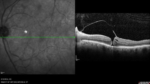 Macular Hole Left Eye - progression from VMT - Stage II macular hole - Spontaneously Closed Macular Hole
Vision has dropped to 20/50 and there is a full thickness macular hole
