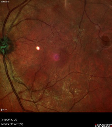 Vitreomacular Traction -> Macular Hole -> Aborted Macular hole
Progression of VMT in both eyes over time
