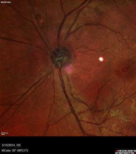 Vitreomacular Traction -> Macular Hole -> Aborted Macular hole
Progression of VMT in both eyes over time
