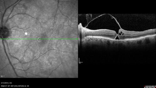 Vitreomacular Traction -> Macular Hole -> Aborted Macular hole
Progression of VMT in both eyes over time

