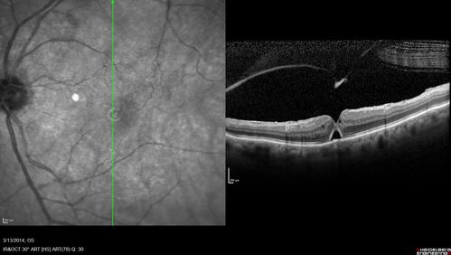 Vitreomacular Traction -> Macular Hole -> Aborted Macular hole
Progression of VMT in both eyes over time
