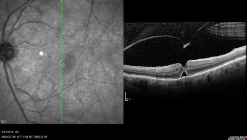 Macular Hole Left Eye - progression from VMT - Stage II macular hole - Spontaneously Closed Macular Hole
Macular hole is closing and vision has improved to 20/40
