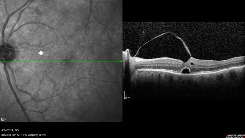 Vitreomacular Traction -> Macular Hole -> Aborted Macular hole
Progression of VMT in both eyes over time
