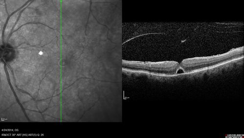 Macular Hole Left Eye - progression from VMT - Stage II macular hole - Spontaneously Closed Macular Hole
Macular hole is closing and vision has improved to 20/40
