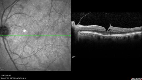 Vitreomacular Traction -> Macular Hole -> Aborted Macular hole
Progression of VMT in both eyes over time

