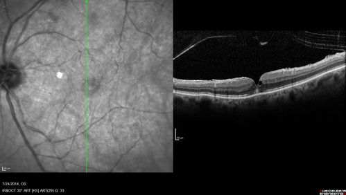 Macular Hole Left Eye - progression from VMT - Stage II macular hole - Spontaneously Closed Macular Hole
Vision has improved to 20/40 and the hole is closed
