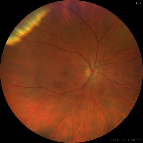 Retinal Angioma
53 year old female with no-symptoms and no significant medical history (or family history)
