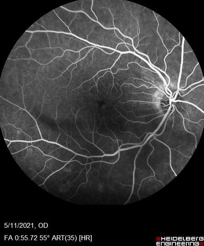 Retinal Angioma
53 year old female with no-symptoms and no significant medical history (or family history)
