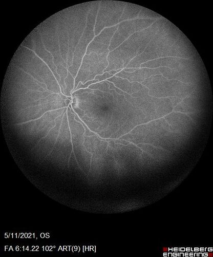 Retinal Angioma
53 year old female with no-symptoms and no significant medical history (or family history)
