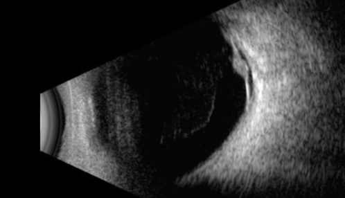Retinal Angioma
53 year old female with no-symptoms and no significant medical history (or family history)
