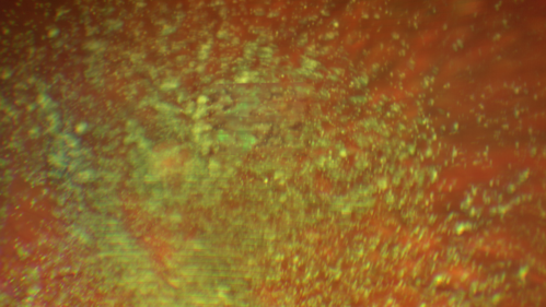 Asteroid Hyalosis -  Clarus Color Image
