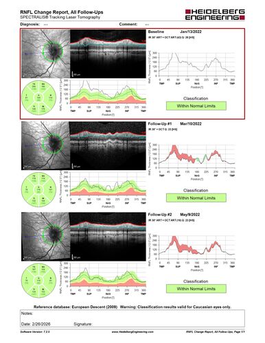 Optic Disc Drusen in a child (non Calcified)
Fluorescein angiography shows no leakage
