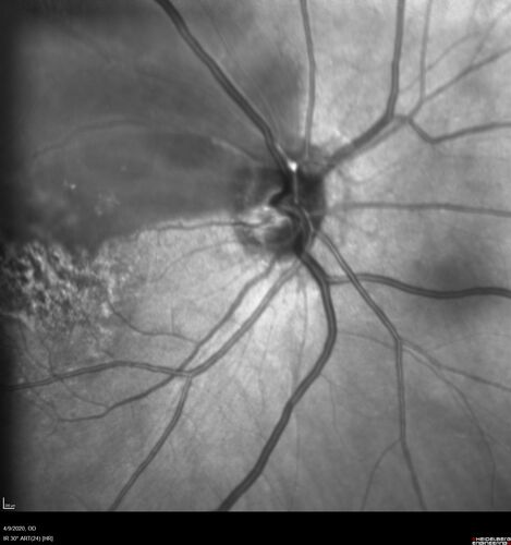 Acute Branch Retinal Arteriolar Occlusion
75 year old female treated for wet AMD with 2 days of inferior shadow in the right eye.  VA 20/40.  There is a plaque visible and retinal whitening from the arteriolar occlusion.
