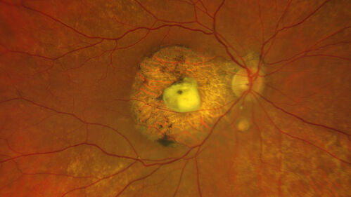 BRAO - plaques in vessels - GIF video of FA
78 year old female with vision loss for 1 week and old macular scar.  Images show BRAO with plaques and FA shows occlusion.
