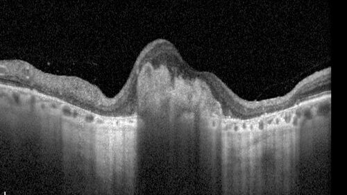BRAO - plaques in vessels - GIF video of FA
78 year old female with vision loss for 1 week and old macular scar.  Images show BRAO with plaques and FA shows occlusion.
