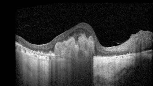 BRAO - plaques in vessels - GIF video of FA
78 year old female with vision loss for 1 week and old macular scar.  Images show BRAO with plaques and FA shows occlusion.

