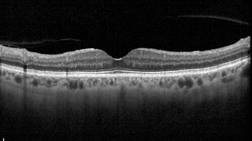 BRAO - plaques in vessels - GIF video of FA
78 year old female with vision loss for 1 week and old macular scar.  Images show BRAO with plaques and FA shows occlusion.
