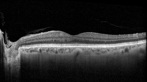BRAO - plaques in vessels - GIF video of FA
78 year old female with vision loss for 1 week and old macular scar.  Images show BRAO with plaques and FA shows occlusion.
