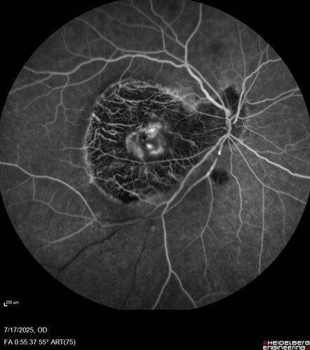 BRAO - plaques in vessels - GIF video of FA
78 year old female with vision loss for 1 week and old macular scar.  Images show BRAO with plaques and FA shows occlusion.
