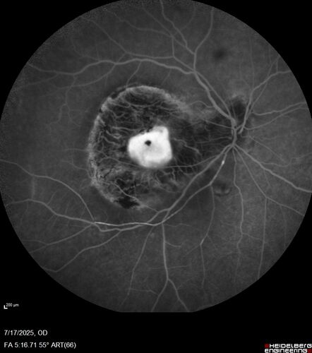 BRAO - plaques in vessels - GIF video of FA
78 year old female with vision loss for 1 week and old macular scar.  Images show BRAO with plaques and FA shows occlusion.
