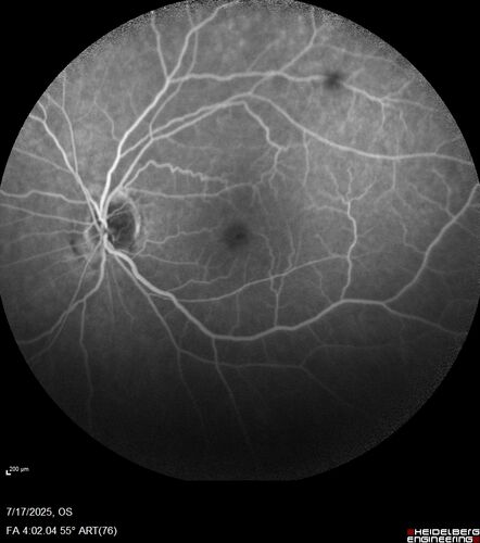 BRAO - plaques in vessels - GIF video of FA
78 year old female with vision loss for 1 week and old macular scar.  Images show BRAO with plaques and FA shows occlusion.
