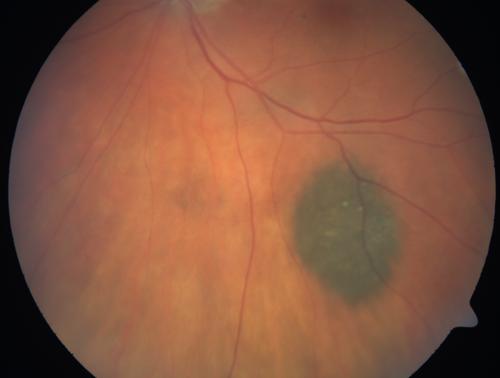 Choroidal Nevus
