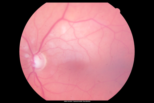 Acute Branch Retinal Artery Occlusion Left Eye
This 84 year old woman had an old BRVO in the right eye and saw a shadow for 2 days in the left eye.  She has a superotemporal BRAO.  The photos show retinal whitening, the OCT shows inner retinal edema and the FA shows poor circulation.
