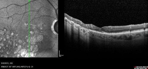 Acute Branch Retinal Artery Occlusion Left Eye
This 84 year old woman had an old BRVO in the right eye and saw a shadow for 2 days in the left eye.  She has a superotemporal BRAO.  The photos show retinal whitening, the OCT shows inner retinal edema and the FA shows poor circulation.
