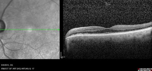 Acute Branch Retinal Artery Occlusion Left Eye
This 84 year old woman had an old BRVO in the right eye and saw a shadow for 2 days in the left eye.  She has a superotemporal BRAO.  The photos show retinal whitening, the OCT shows inner retinal edema and the FA shows poor circulation.
