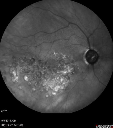 Acute Branch Retinal Artery Occlusion Left Eye
This 84 year old woman had an old BRVO in the right eye and saw a shadow for 2 days in the left eye.  She has a superotemporal BRAO.  The photos show retinal whitening, the OCT shows inner retinal edema and the FA shows poor circulation.
