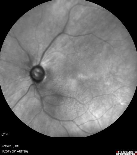 Acute Branch Retinal Artery Occlusion Left Eye
This 84 year old woman had an old BRVO in the right eye and saw a shadow for 2 days in the left eye.  She has a superotemporal BRAO.  The photos show retinal whitening, the OCT shows inner retinal edema and the FA shows poor circulation.
