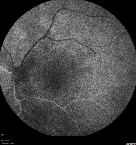 Acute Branch Retinal Artery Occlusion Left Eye
This 84 year old woman had an old BRVO in the right eye and saw a shadow for 2 days in the left eye.  She has a superotemporal BRAO.  The photos show retinal whitening, the OCT shows inner retinal edema and the FA shows poor circulation.
