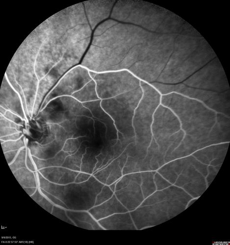 Acute Branch Retinal Artery Occlusion Left Eye
This 84 year old woman had an old BRVO in the right eye and saw a shadow for 2 days in the left eye.  She has a superotemporal BRAO.  The photos show retinal whitening, the OCT shows inner retinal edema and the FA shows poor circulation.
