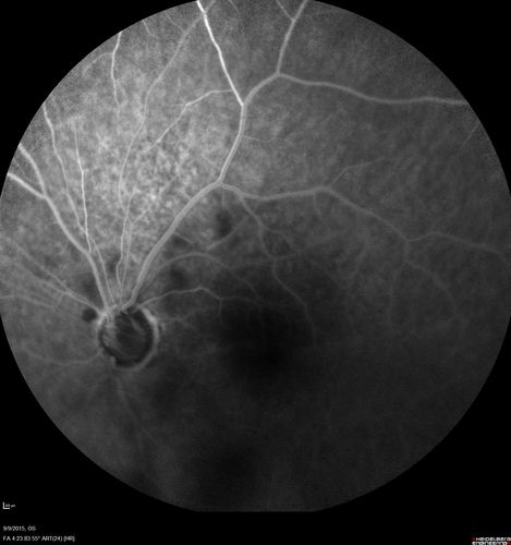 Acute Branch Retinal Artery Occlusion Left Eye
This 84 year old woman had an old BRVO in the right eye and saw a shadow for 2 days in the left eye.  She has a superotemporal BRAO.  The photos show retinal whitening, the OCT shows inner retinal edema and the FA shows poor circulation.
