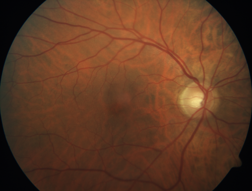 Subtle Branch Retinal Artery Occlusion
68 year old man with shadow in the left eye yesterday.  IR and OCT show subtle retinal swelling.  FA is normal

